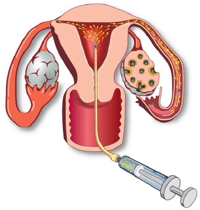 Khi nào nên thực hiện bơm tinh trùng vào buồng tử cung (IUI)?