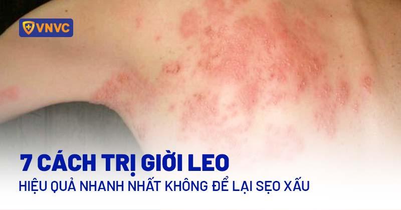 7 cách trị giời leo hiệu quả nhanh nhất không để lại sẹo xấu