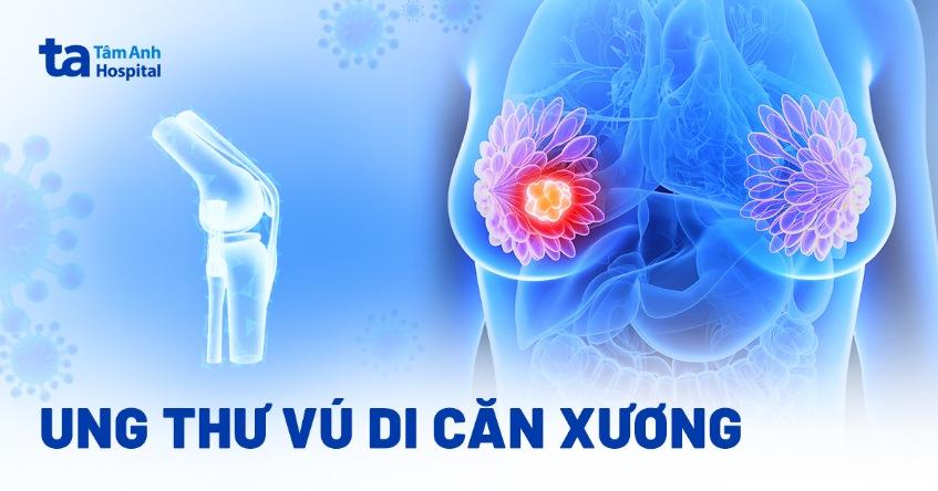 Ung thư vú di căn xương có chữa được không? Dấu hiệu và 3 vị trí bệnh