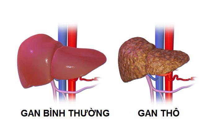 Gan thô: biến chứng về bệnh gan và cách điều trị