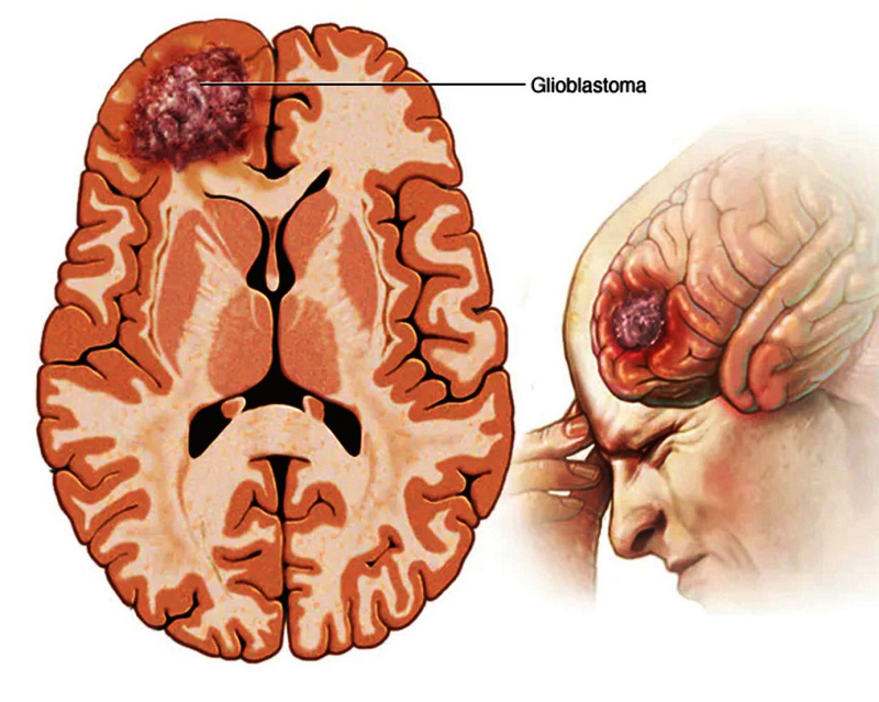Bệnh nhân ung thư não sống được bao lâu? Tiên lượng thời gian sống