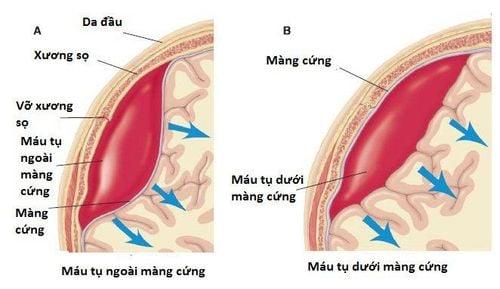 Máu tụ dưới màng cứng và những biến chứng nguy hiểm