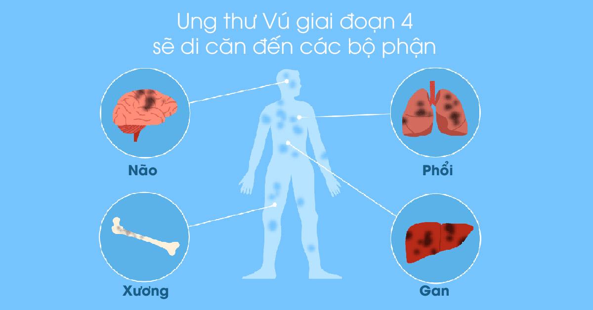 Ung thư vú từng giai đoạn 0, 1, 2, 3, 4 có chữa khỏi được không?