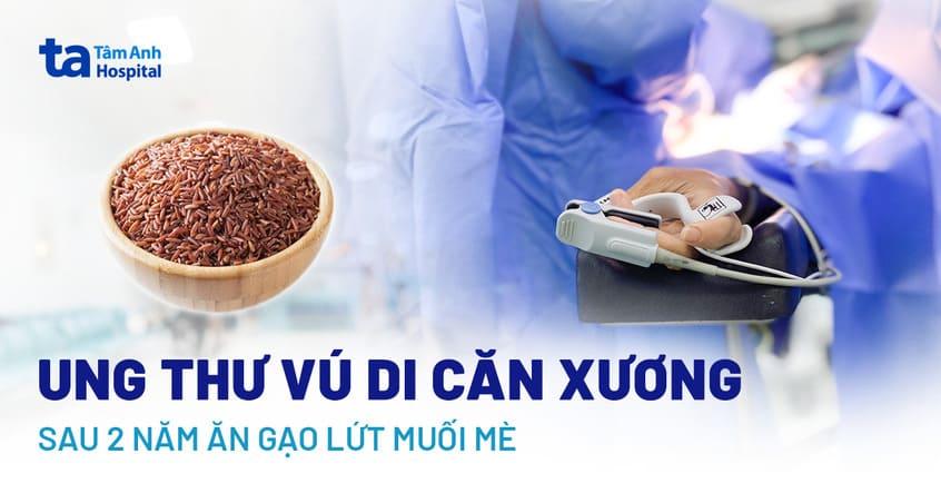 Ung thư vú di căn xương