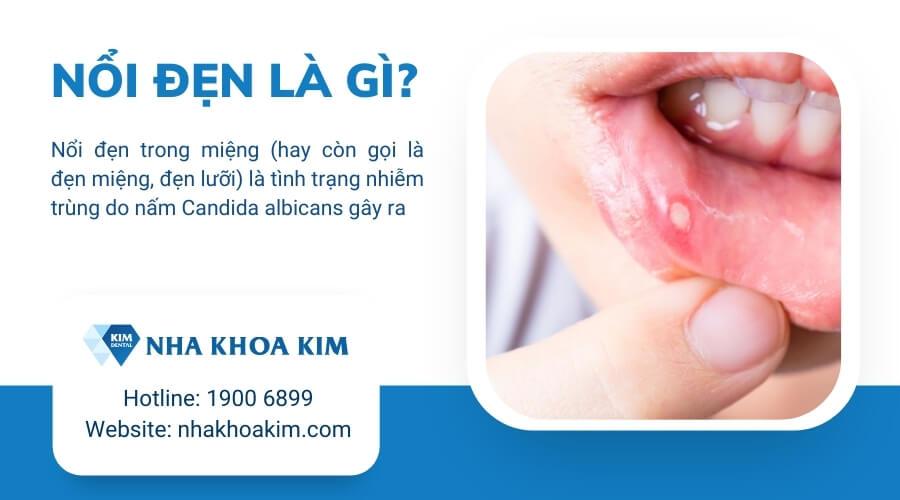 Nổi đẹn là gì?