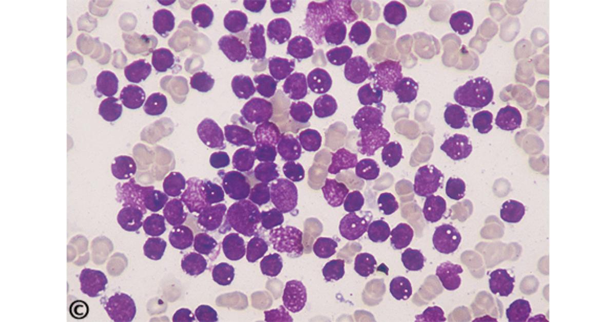 Ung thư máu bạch cầu cấp thể L3 trên tiêu bản máu ngoại vi - Ảnh: Labnotes 123