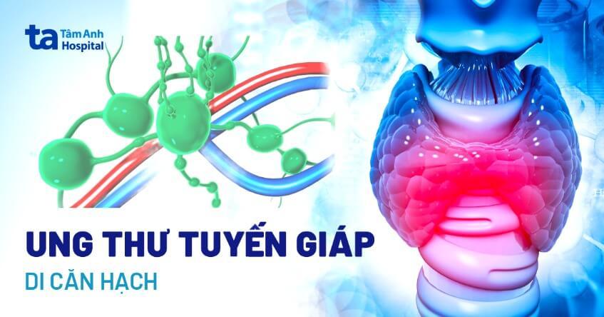 ung thư tuyến giáp di căn hạch