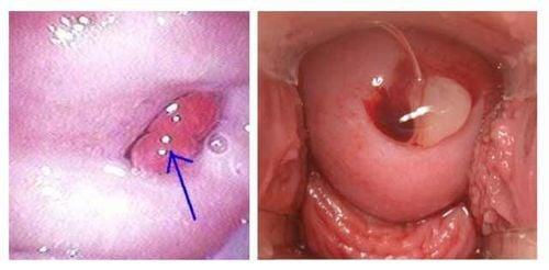 Polyp cổ tử cung và nguy cơ tiến triển ác tính