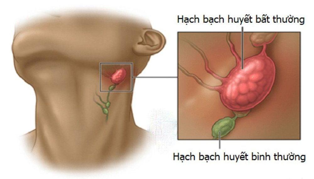 Sưng các hạch bạch huyết trên cơ thể