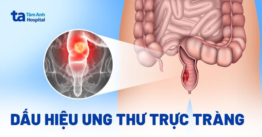 5 dấu hiệu ung thư trực tràng dễ nhận biết, đừng bỏ qua